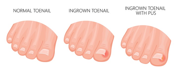 normal toenail, ingrown toenail, and ingrown toenail with pus 