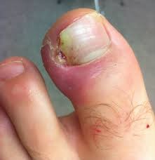 Ingrown toenail with pus