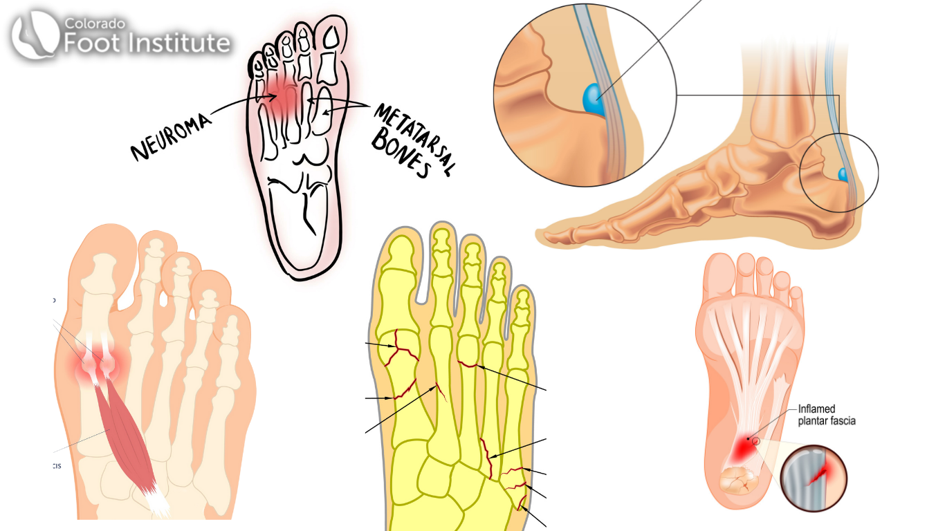 Foot Pain, Dr Joseph E Mechanik